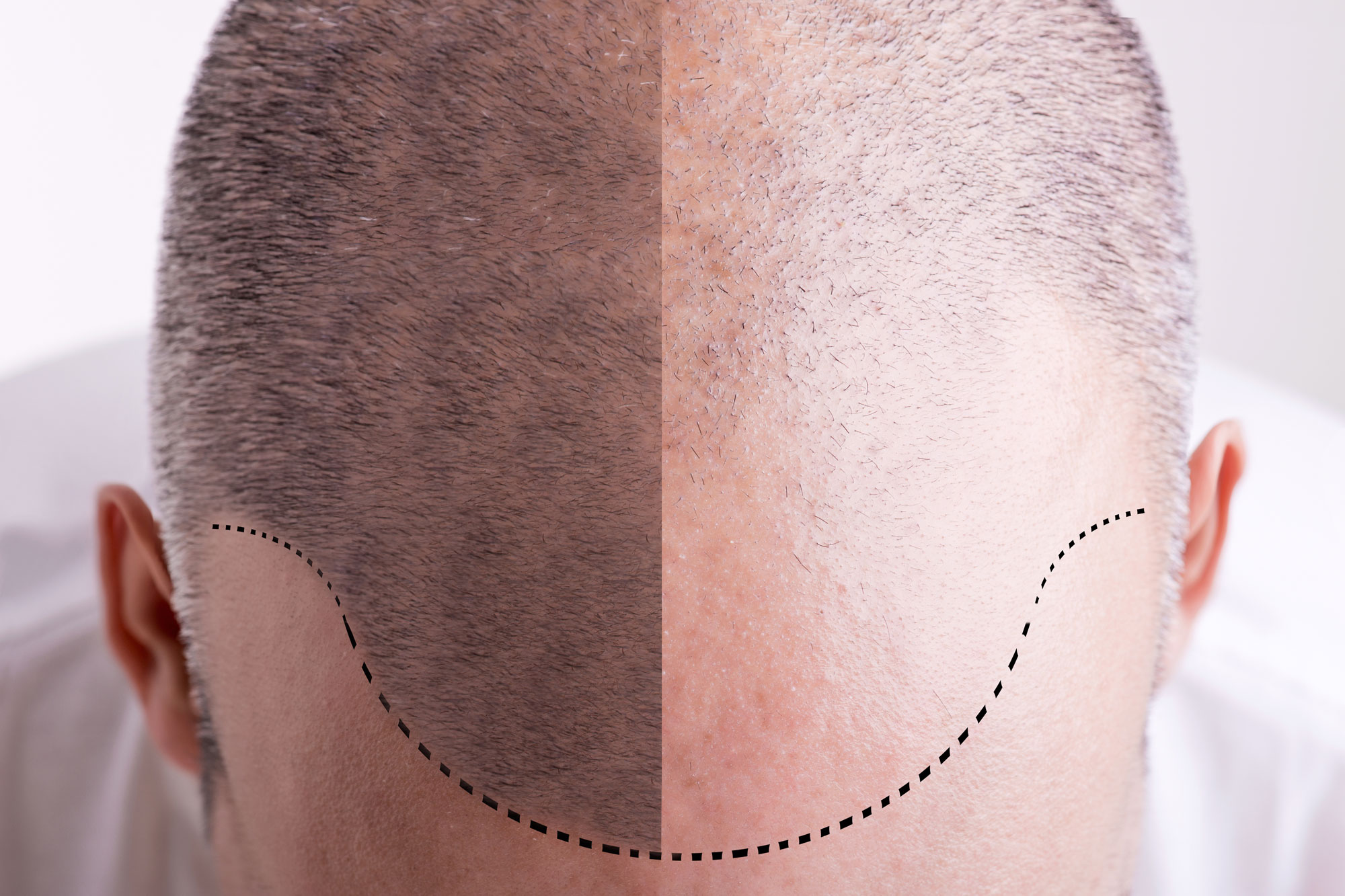 hair-transplant-cost-abroad