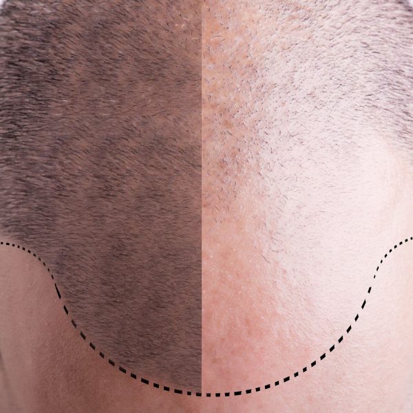 Can You Trust Your Hair Transplant Provider