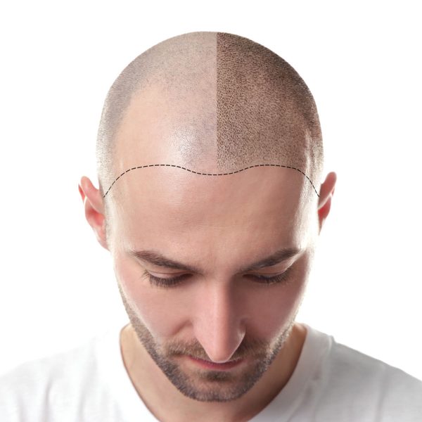 hair-loss-hair-transplant-man-man-for-himself-ft.jpeg