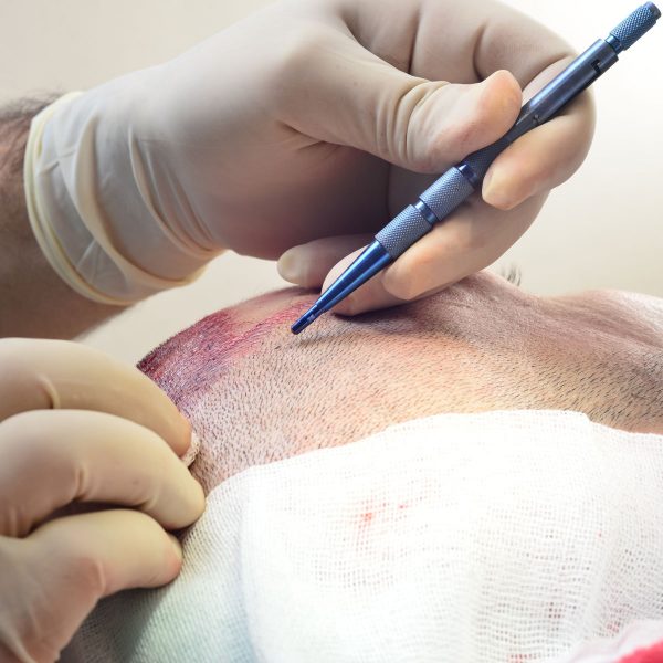 Hair Transplant Industry: What You Need To Know! 