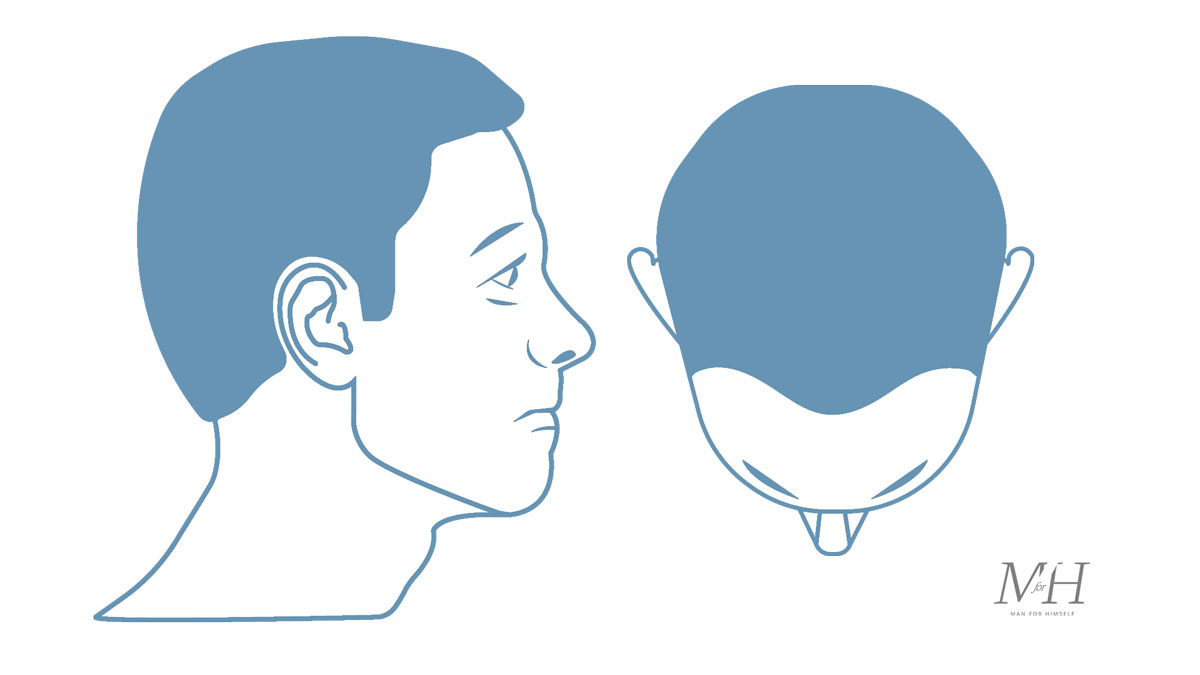 Stage-1-Hair-Loss-Stages-Man-For-Himself