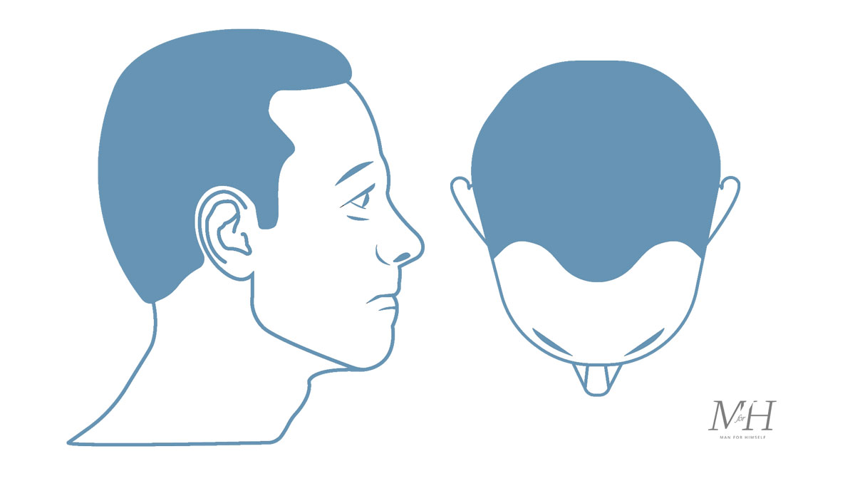 Stage-2-Hair-Loss-Stages-Man-For-Himself