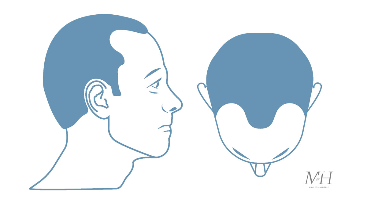 Stage-3-Hair-Loss-Stages-Man-For-Himself