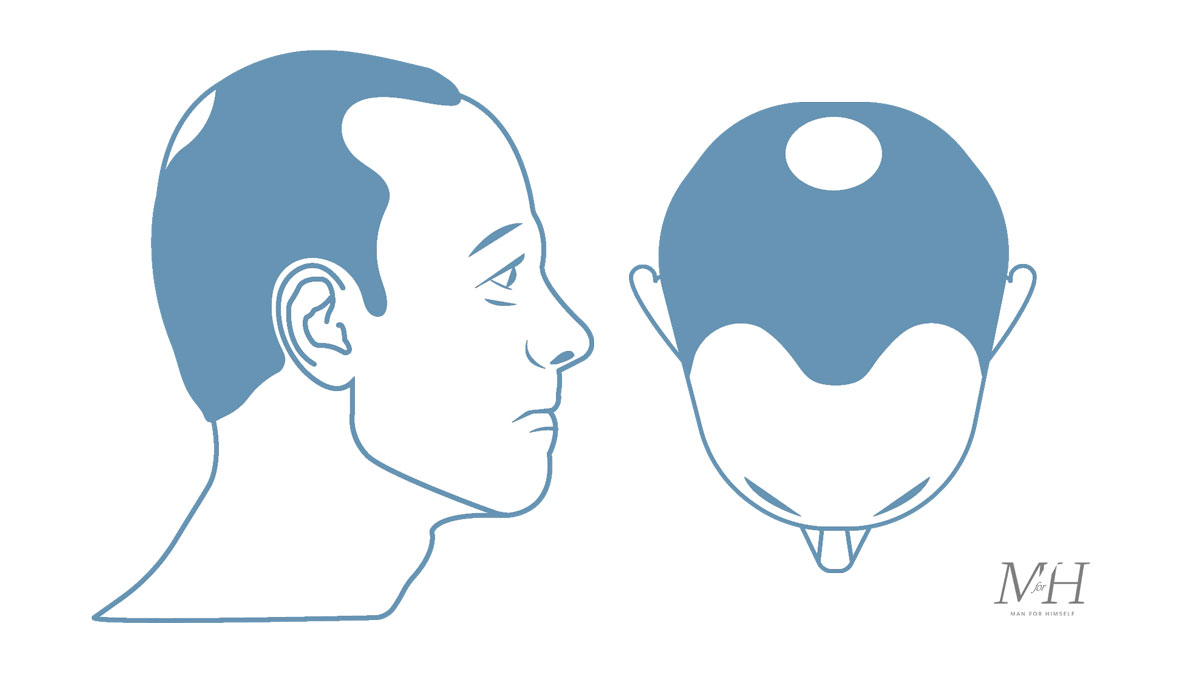 Stage-3-Vertex-Hair-Loss-Stages-Man-For-Himself