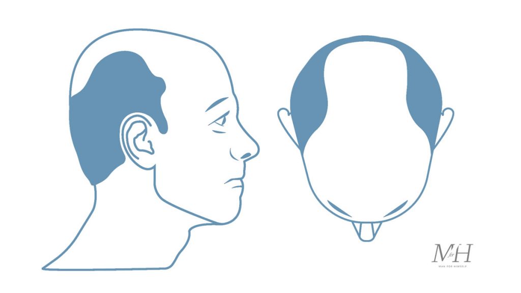 Stage-6-Hair-Loss-Stages-Man-For-Himself