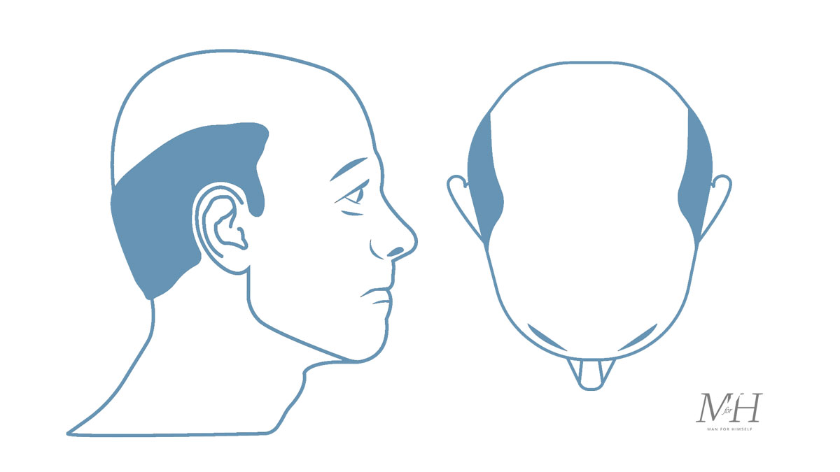 Stage-7-1-Hair-Loss-Stages-Man-For-Himself