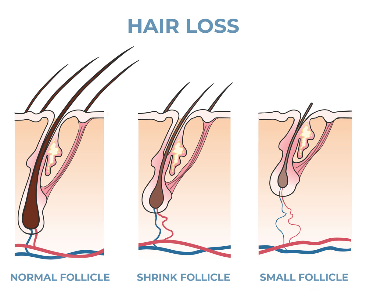 HAIR-LOSS-FOLLICLE-MAN-FOR-HIMSELF