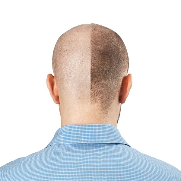 reverse-hair-loss-how-to-man-for-himself