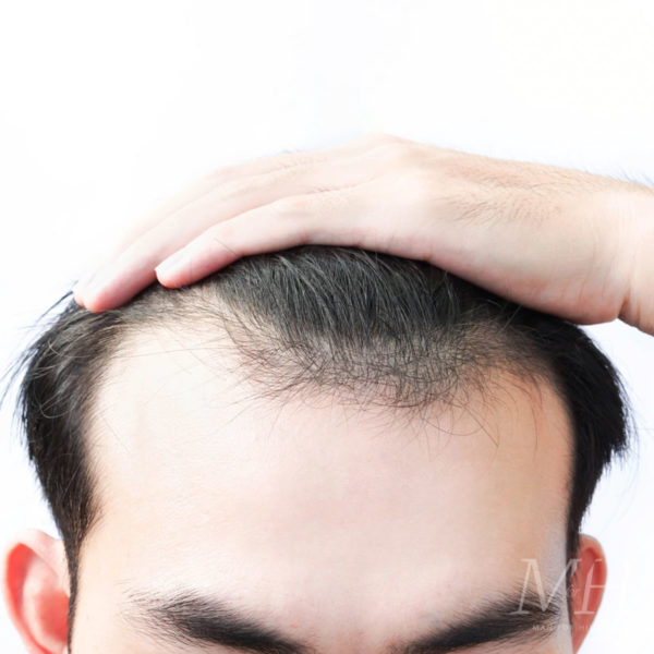 Hair Transplants Explained | Your Questions Answered