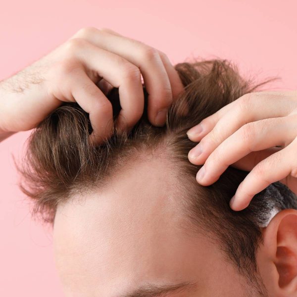 Men’s Hair Loss: When To Take Action and Effective Treatments